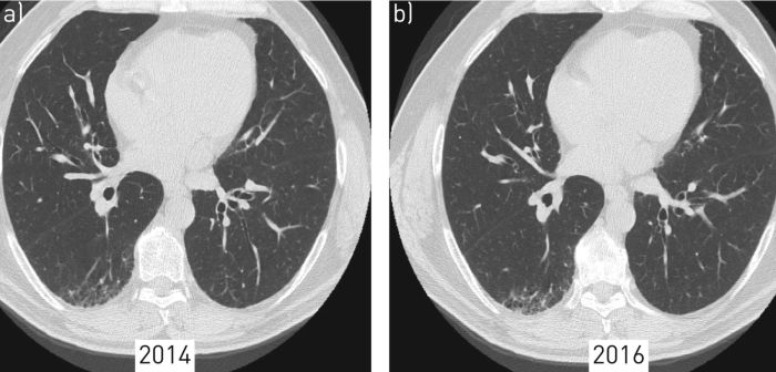 Disease parenchymal diffuse lung figure