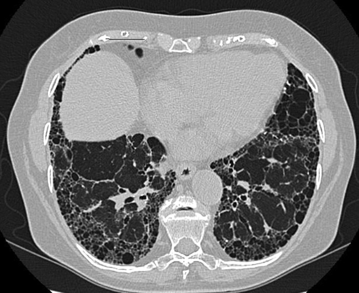 Parenchymal lung disease