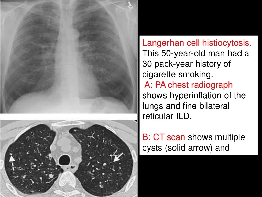 Parenchymal lung disease