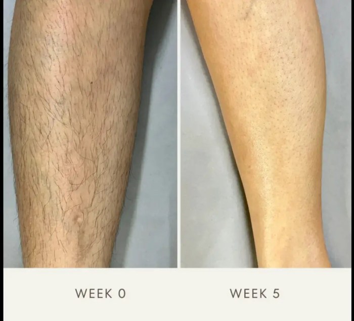 Illumi laser hair removal reviews